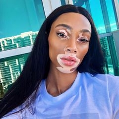 Kalıpları Yıkan Model Winnie Harlow galerisi resim 4