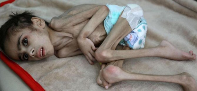 Yemen'de açlığın tablosu: 7 yaşında 7 kilo