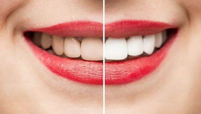 Diş beyazlatma (Bleaching) nedir?