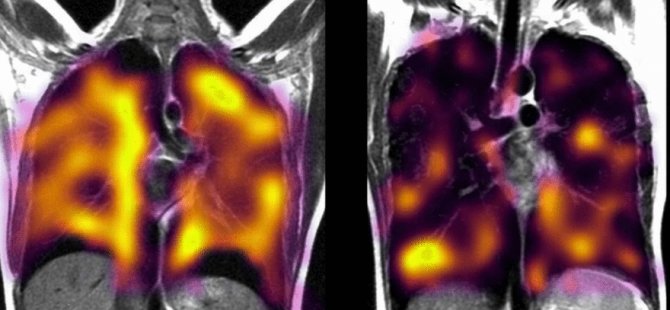 Covid Sonrası Nefes Problemi Yaşayanlar Dikkat: Gizli Akciğer Hasarına İşaret Ediyor Olabilir