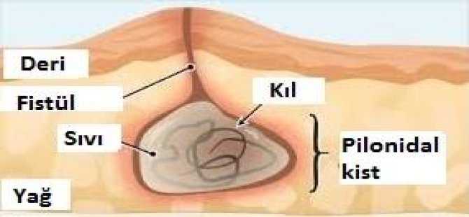 Kıl Dönmesi Nedir?