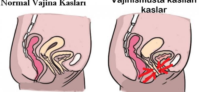 Cinsellikle İlgili Yanlış İnanışlar Vajinismusa Yol Açabilir