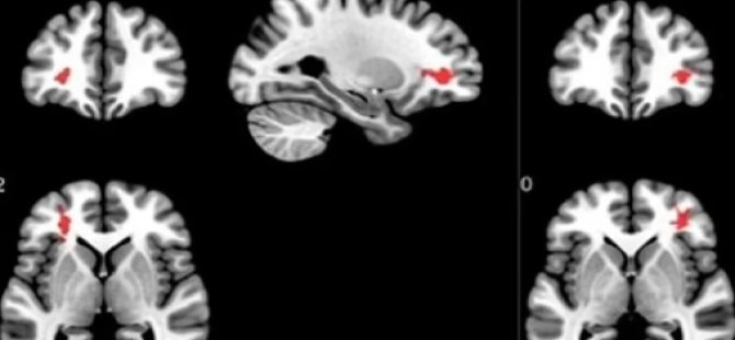Covid-19 geçirenlerin beyinlerini incelediler: Endişe yaratan sonuç