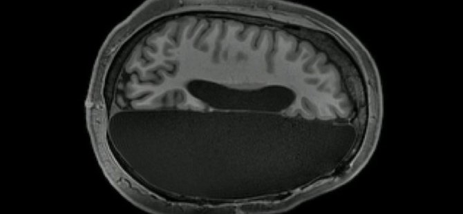'Beyninin yarısı alınan insanlar normal yaşamını sürdürüyor'