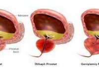 Ailede meme kanseri öyküsü prostat kanseri riskini artırıyor 