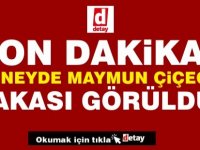 Güney Kıbrıs’ta ilk maymun çiçeği vakası saptandı