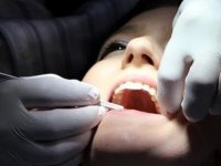 Endodonti nedir, nasıl yapılır? Endodonti hakkında bilgiler