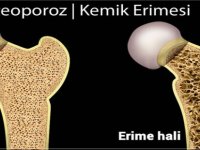 Osteoporoz “Kemik Erimesi” günümüzde önemli bir sağlık problemi